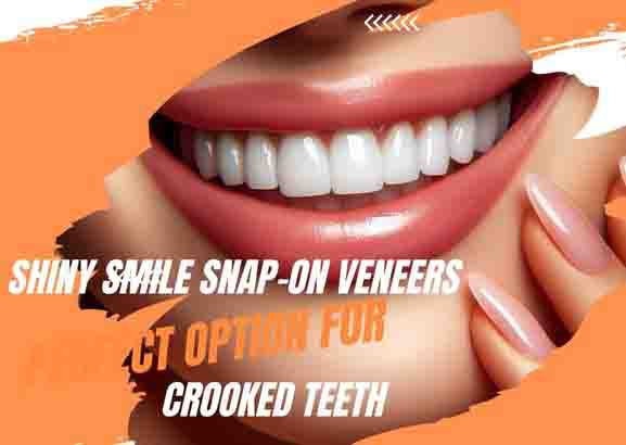 Snap on Veneers for Crooked Teeth