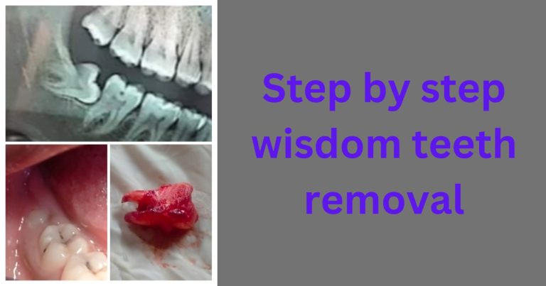 Step by Step Wisdom Tooth Removal: A Pain-Free Journey