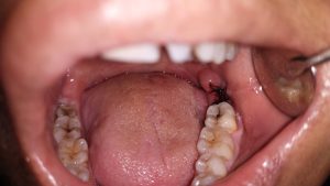 Surgery after extraction