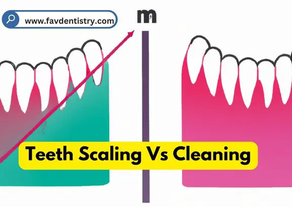 Teeth Scaling Vs Cleaning