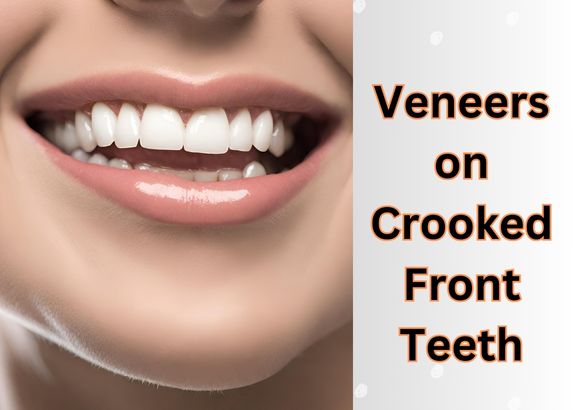 Transform Your Smile: Veneers on Crooked Front Teeth for a Flawless Look
