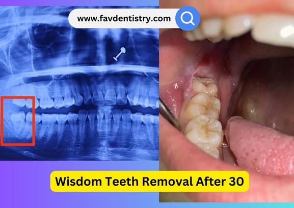 Wisdom Teeth Removal After 30