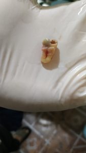 extracted tooth