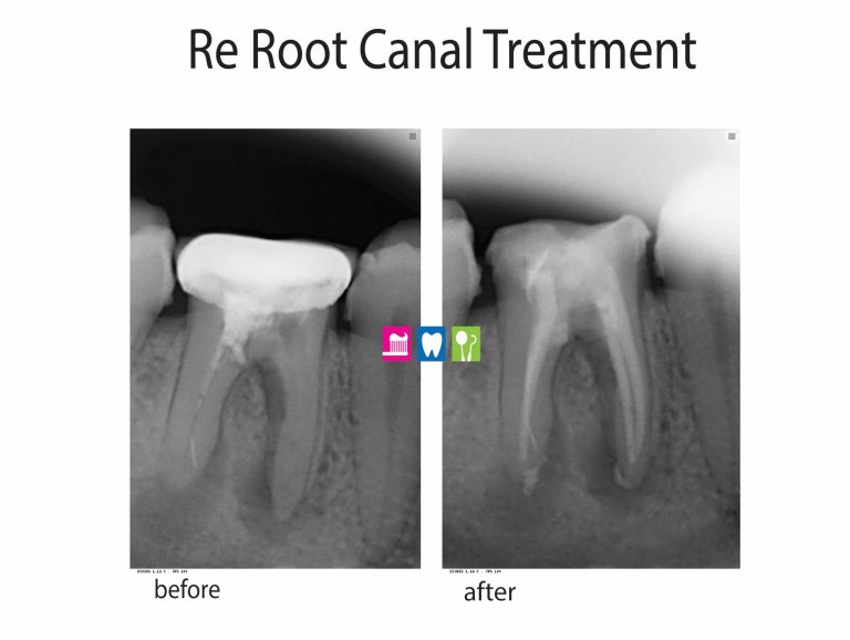 Can a Bad Root Canal Make You Sick? Unveiling the Hidden Risks