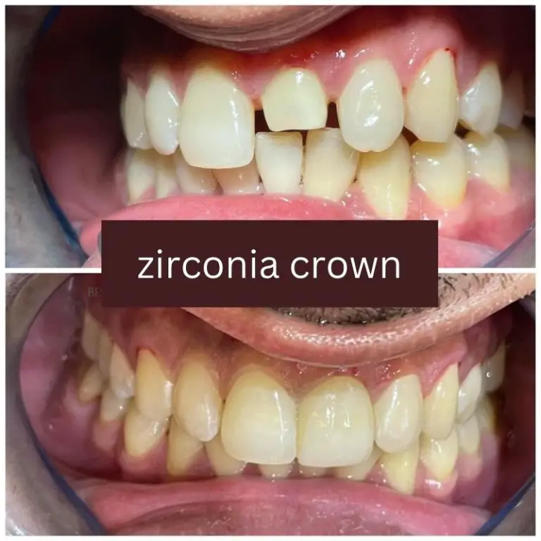 zirconia crown