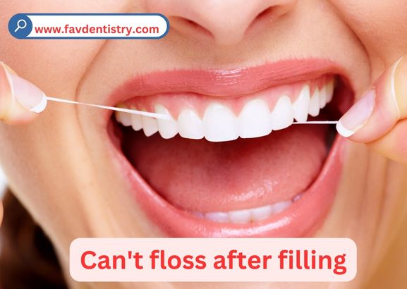 Can’t floss after filling : Safe Flossing Post Fillings