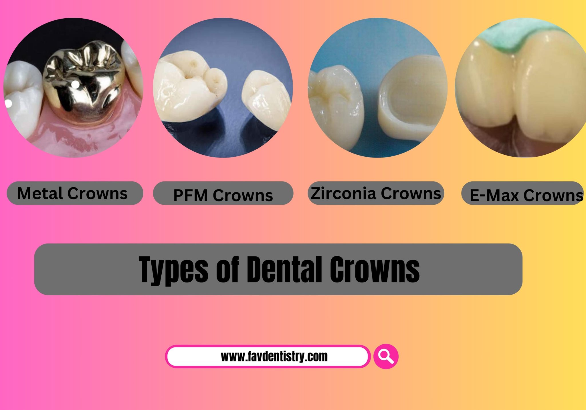 Types of Dental Crowns - favourite dentistry