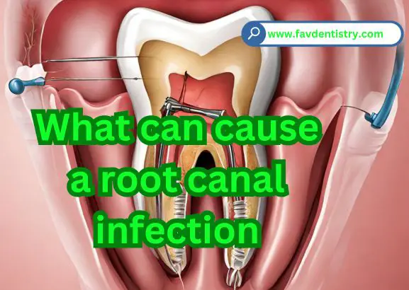 What can cause a root canal infection