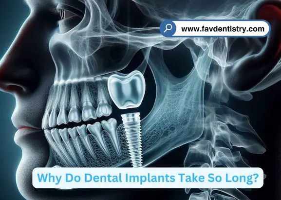 Why Do Dental Implants Take So Long?