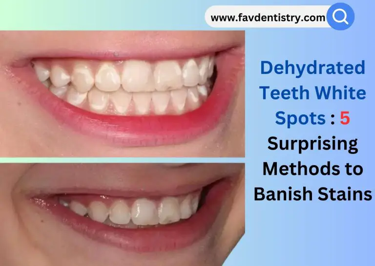 Dehydrated Teeth White Spots