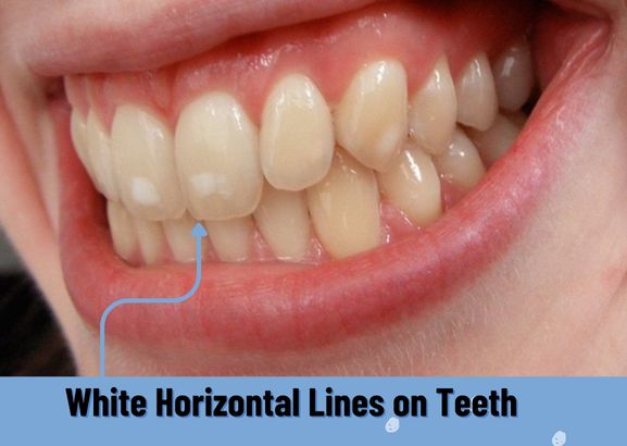 White Horizontal Lines on Teeth: Decoding Dental Stripes
