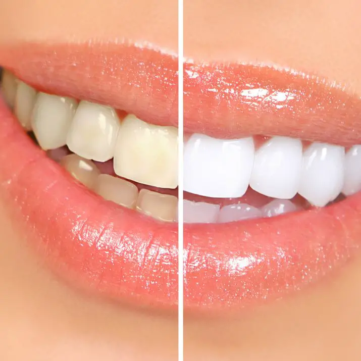 Accidentally Drank Coffee After Teeth Whitening: Beware of Stains!