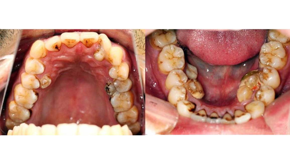 Extra Teeth Growing In Adults : Causes And Solutions - Favourite Dentistry