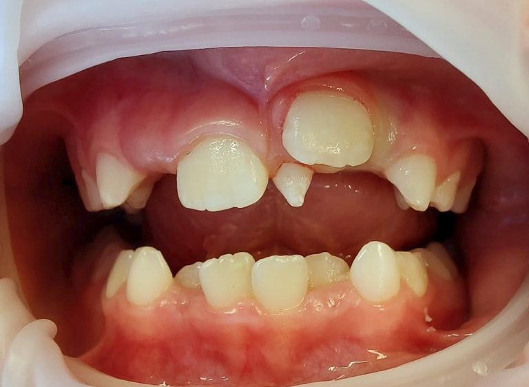 Extra Teeth Growing in Gums: Understanding the Phenomenon