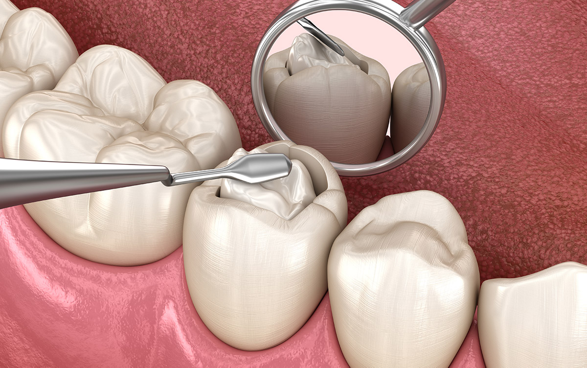 How Much Does a Cavity Filling Cost Without Insurance