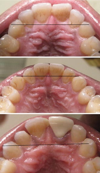 Incisal Papilla Swollen