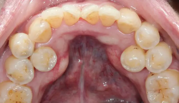 Mesiodens Tooth Numbering  : Everything You Need to Know