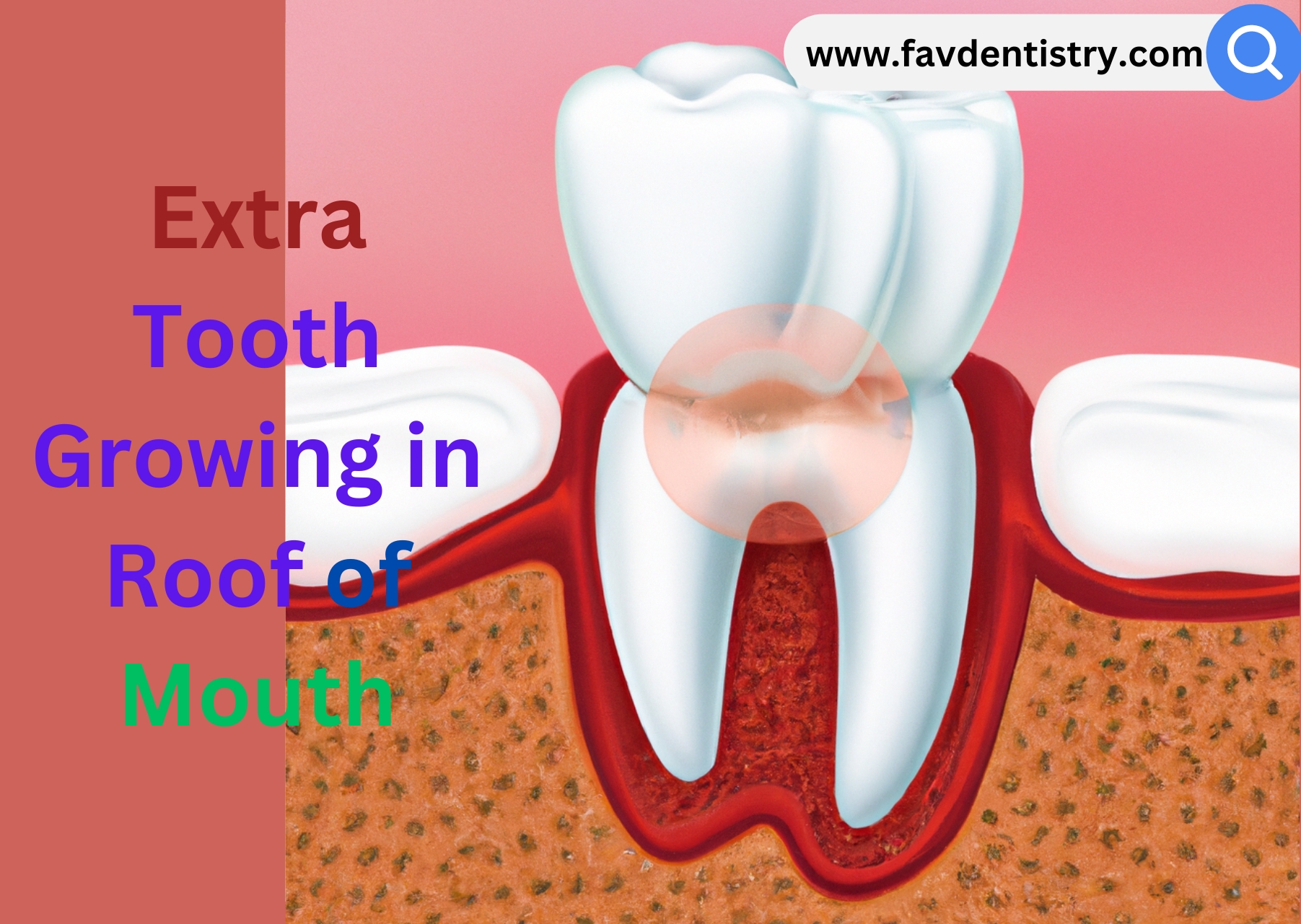 Extra Tooth Growing in Roof of Mouth: Navigating Oral Anomalies ...