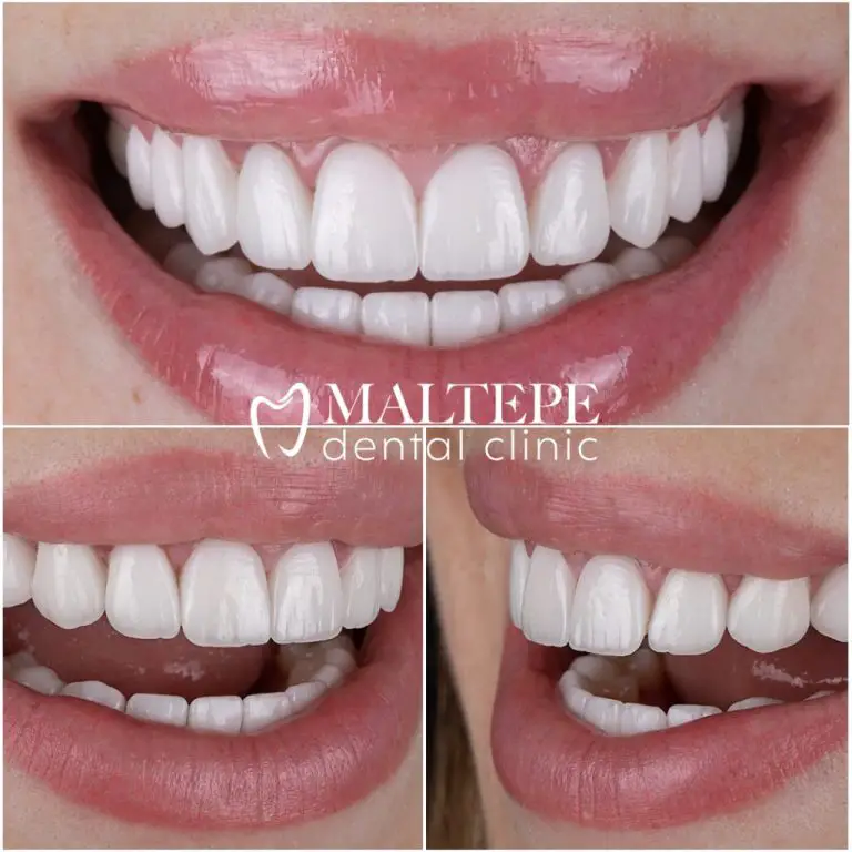 Perfect Teeth: 5 Secrets to a Dazzling Smile!