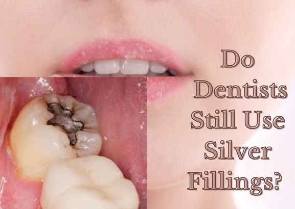 Do Dentists Still Use Silver Fillings