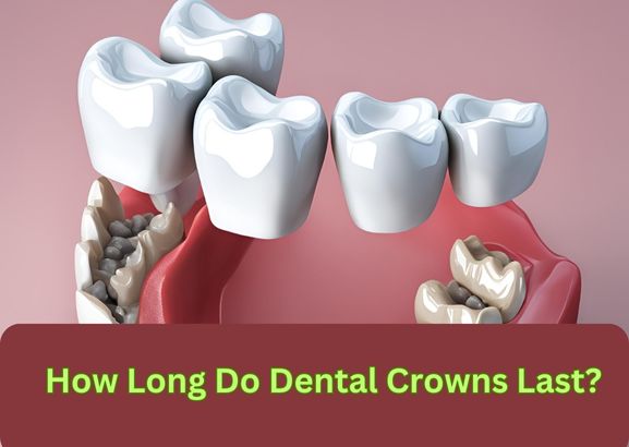 How Long Do Dental Crowns Last?