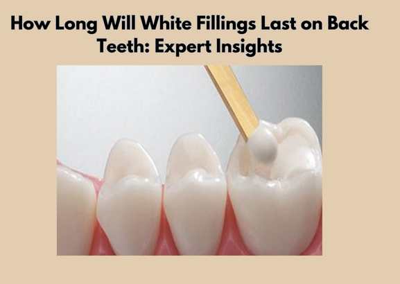 How Long Will White Fillings Last on Back Teeth