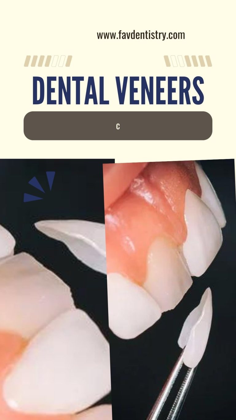 Lifespan of Dental Veneers