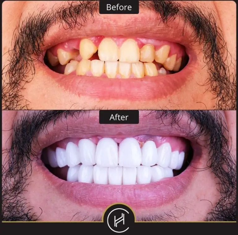 Best Turkish Dental Implants: Top Choices for a Perfect Smile
