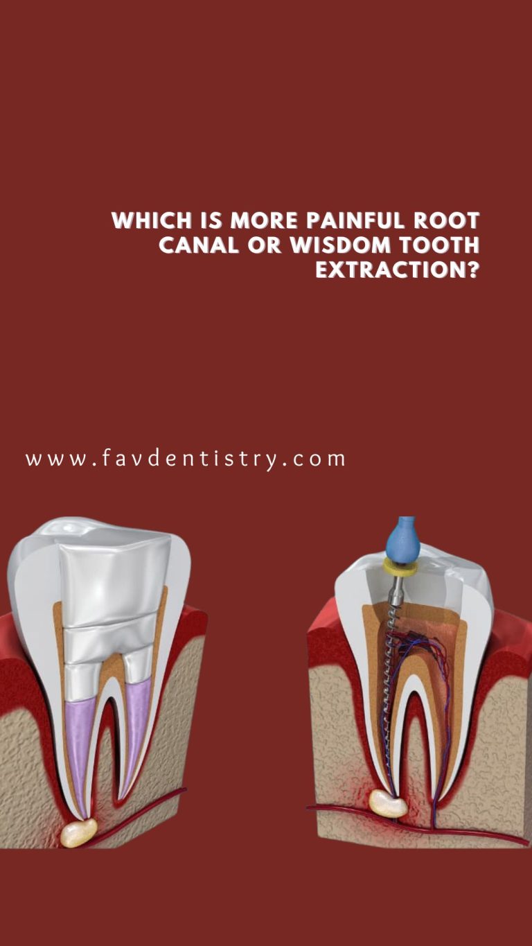 Which is More Painful Root Canal Or Wisdom Tooth Extraction?