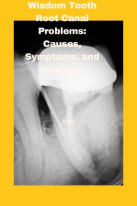 Wisdom Tooth Root Canal Problems