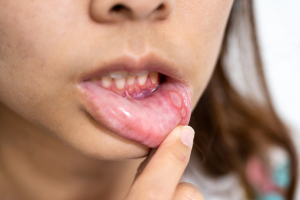 How to Heal Mouth Sores from Invisalign