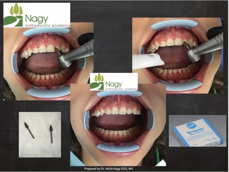 How to Remove Invisalign Attachments