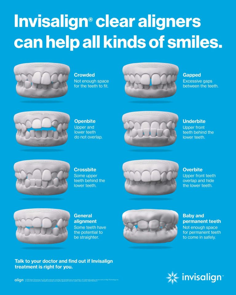 Invisalign for Malocclusion