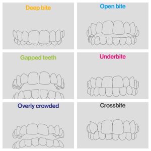 Invisalign Issues