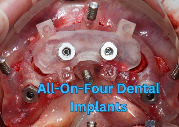 All-On-Four Dental Implants