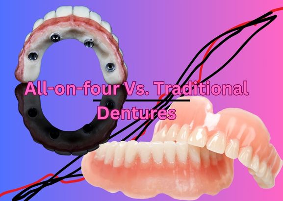 All-on-four Vs. Traditional Dentures