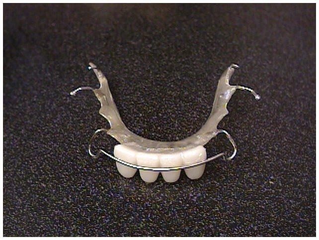 Replacement Retainers for Teeth